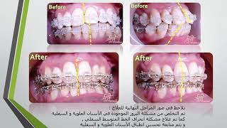 علاج بروز الأسنان العلوية و السفلية من خلال تقويم الأسنان Orthodontic treatment of teeth protrusion [upl. by Illa]