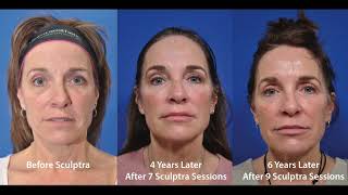 Do You Want to See Amazing Sculptra Results [upl. by Anirahs]