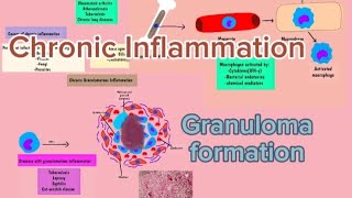 Pathology 11 Chronic inflammation Granulomatous Inflammation  AfSoomaali [upl. by Hengel]