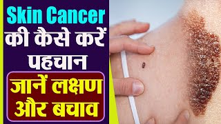 Skin Cancer की ऐसे करें पहचान जानें क्या है Symptoms and Precautions  Boldsky [upl. by Enybor]