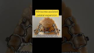 Miniscrew assisted palatal expansion dentist miniscrew manavgatdentist side [upl. by Mitzl709]