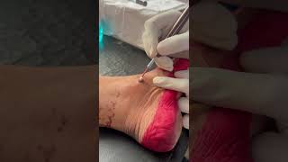 Common wart treatmentshortsdermatologistyoutubeshortselectrocauterymusic [upl. by Hermine]