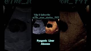 Pyogenic Liver Abscess doctor baby abdomen usg pregnant pregnancyjourney education [upl. by Scornik]