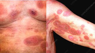 What is Mycosis Fungoides Symptoms Causes Treatment Diagnosis Cutaneous T Cell Lymphoma [upl. by Dryfoos]