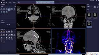 Neuro DSA  برنامج لفصل العظام عن الصبغه [upl. by Eva234]