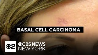 Dermatologist explains the dangers of basal cell carcinoma what to look out for [upl. by Anwahsal]