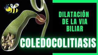 🟢▶️🪨Coledocolitiasis y dilatación de la vía biliar⚠️🪨⚠️ CASO RADIOLOGICO [upl. by Rina]