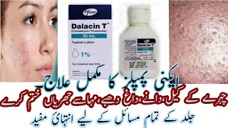 Best Acne Lotion  Dalacin T Lotion  Calindamycin 1 Acne Lotion Review In Urdu Hindi [upl. by Bywoods]