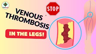 Warning Signs Deep Vein Thrombosis [upl. by Eojyllib]