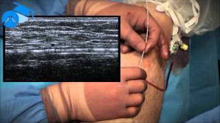 Positioning of endovenous catheter at the SaphenoFemoral Junction varicose veins [upl. by Chariot]