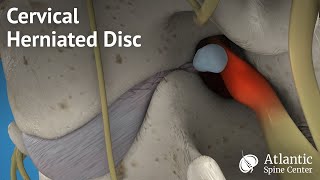 Cervical Herniated Disc [upl. by Atnuahs]