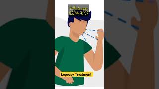 कुष्ठ रोग सुनबहरी Leprosy causes symptoms and homoeopathic treatment drkailashprasad [upl. by Anieral]