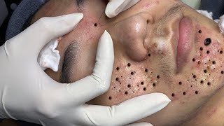 Satisfying Relaxing Acne Treatment 2024 With Sac Dep Spa [upl. by Droflim]