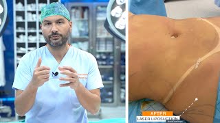 Laser Liposuction Procedure [upl. by Linoel]