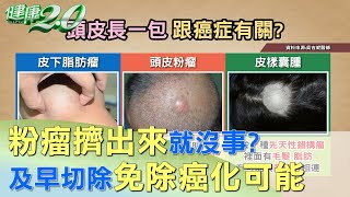 粉瘤擠出來就沒事？ 及早切除免除癌化可能 健康20 [upl. by Ekralc]