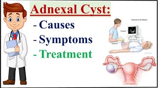 Adnexal cyst Causes Symptoms and Treatment of Adnexal cyst [upl. by Ursel]