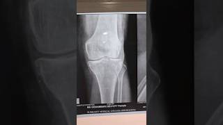 osteoarthritis knee Xray doctor osteoarthritisoftheknee osteoarthritis [upl. by Koppel764]