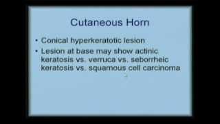 Cutaneous Horn [upl. by Wareing]