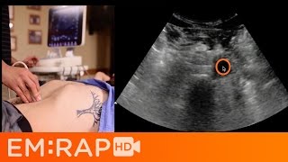 Ultrasound of Abdominal Aortic Aneurysm AAA [upl. by Cannell632]