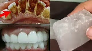 Amazing Recipe Turn Yellow Dirty Teeth to Pearl White Teeth Whitening at Home II NGWorld [upl. by Tracay352]