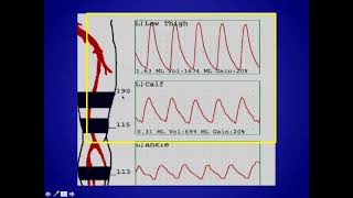 How to Perform and Interpret Peripheral Arterial Doppler Examinations [upl. by Onaireves]