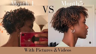 DIY Microlocs 15 Month Loc Journey 5 Months Loc’d [upl. by Kristyn]