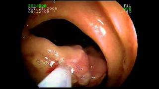 Using Capsule Endoscopy and Double Balloon Enteroscopy for Complex Small Intestinal Disease [upl. by Kevyn]