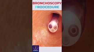 Bronchoscopy Procedure education shorts [upl. by Ellenid]