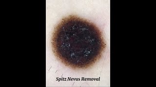 Spitz Nevus surgical removal [upl. by Pournaras]