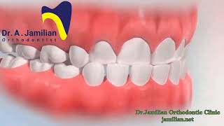 Pseudo Class III Mandibular Overclosure in Orthodontics [upl. by Corbin844]