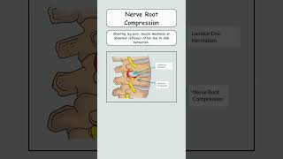 Low Back Pain 5 Key Conditions To Look Out youtube youtubeshorts lowbackpaincauses [upl. by Norehs239]