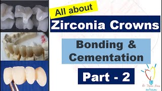 Zirconia Crowns  CEMENTATION vs BONDING [upl. by Aissatan531]