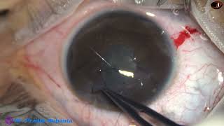 Corneal injury with iris prolapse repaired under peribulbar block Pradip Mohanta 28 October 2023 [upl. by Elicia]