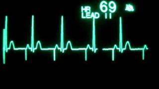 Atrial Pacing [upl. by Sinoda]