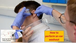 How to Perform an Ear Washout irrigation  ENTOtolaryngology Skills [upl. by Dorran748]