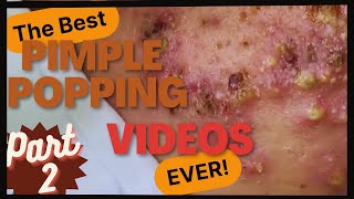 The BEST pimple POPPING videos EVER p2 [upl. by Anerev]