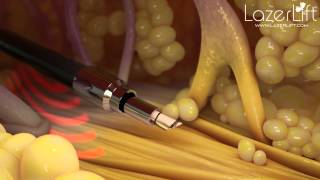 LazerLift  The Minimally Invasive Laser Facelift [upl. by Nolos843]