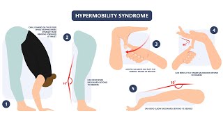 Joint Hypermobility Syndrome  Definition Symptoms Causes Diagnosis Treatment [upl. by Vivie]