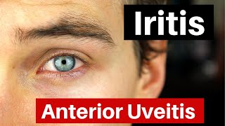 Iritis  What is Anterior Uveitis Doctor Explains [upl. by Arbmahs]