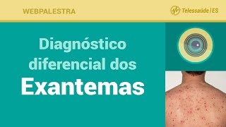 Webpalestra Diagnóstico diferencial dos Exantemas  Telessaúde ES 02062016 [upl. by Refinnaej]