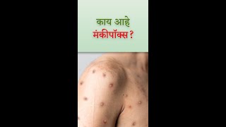 MPOX Monkeypox Information in Marathi  Symptoms  Transmission  Treatment [upl. by Anilas]