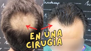 👨‍🦲➡️👨 ¡Espectacular Trasplante Capilar Frontal y Coronilla en una Cirugía Antes y Después 🌟 [upl. by Czarra]