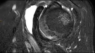 Subcoracoid bursitis [upl. by Enneire]