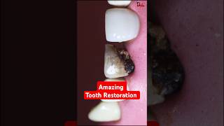 Impossible to save this tooth satisfying asmr missionimpossible [upl. by Elem]