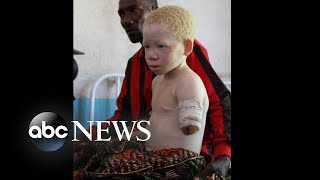 Tanzanian children lost limbs in brutal attacks for having albinism Part 1 [upl. by Phyllys]