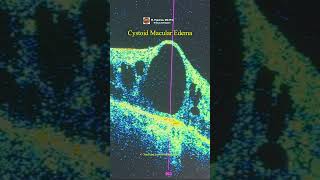 Cystoid Macular Edema OCT [upl. by Enerahs358]