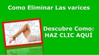 Como Quitar Las Varices  5 Remedios Naturales Para Las Varices [upl. by Aehsal]