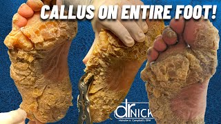 SHAVING CALLUS ON ENTIRE SOLE OF FOOT Dr Nick Campitelli Foot amp Ankle Surgeon [upl. by Livy]