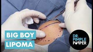 The Big Boy Lipoma [upl. by Nylear]