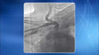 Chapter 14 TRA for addressing Subclavian amp Innominate Artery Lesions [upl. by Algernon]